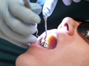 tooth enamel repair