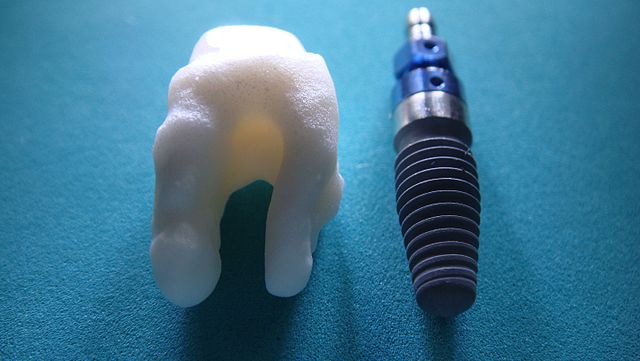 implant tooth
