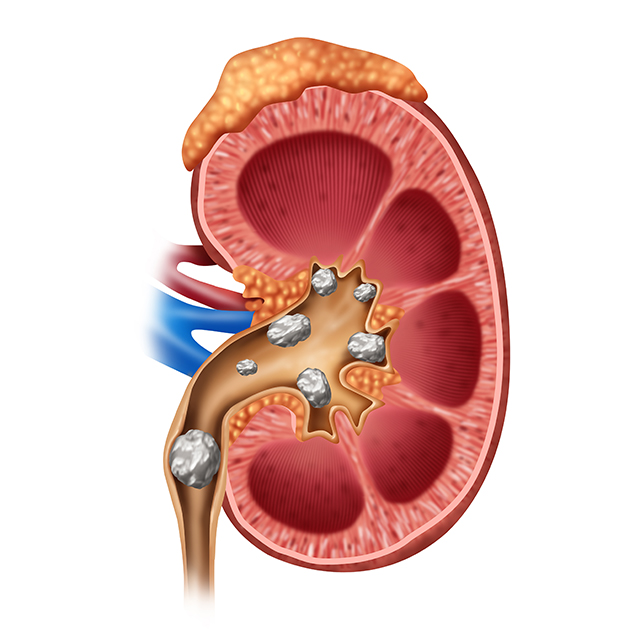 Vitamin C Kidney Stones Oregon Careers In Healthcare
