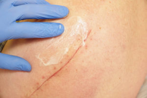 Best Scar Cream After Surgery
