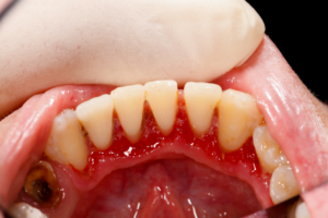 Periodontal diseases