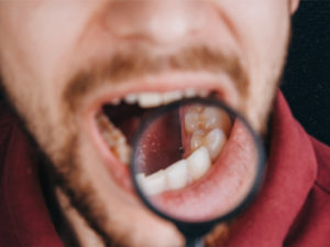 hiv mouth symptoms
