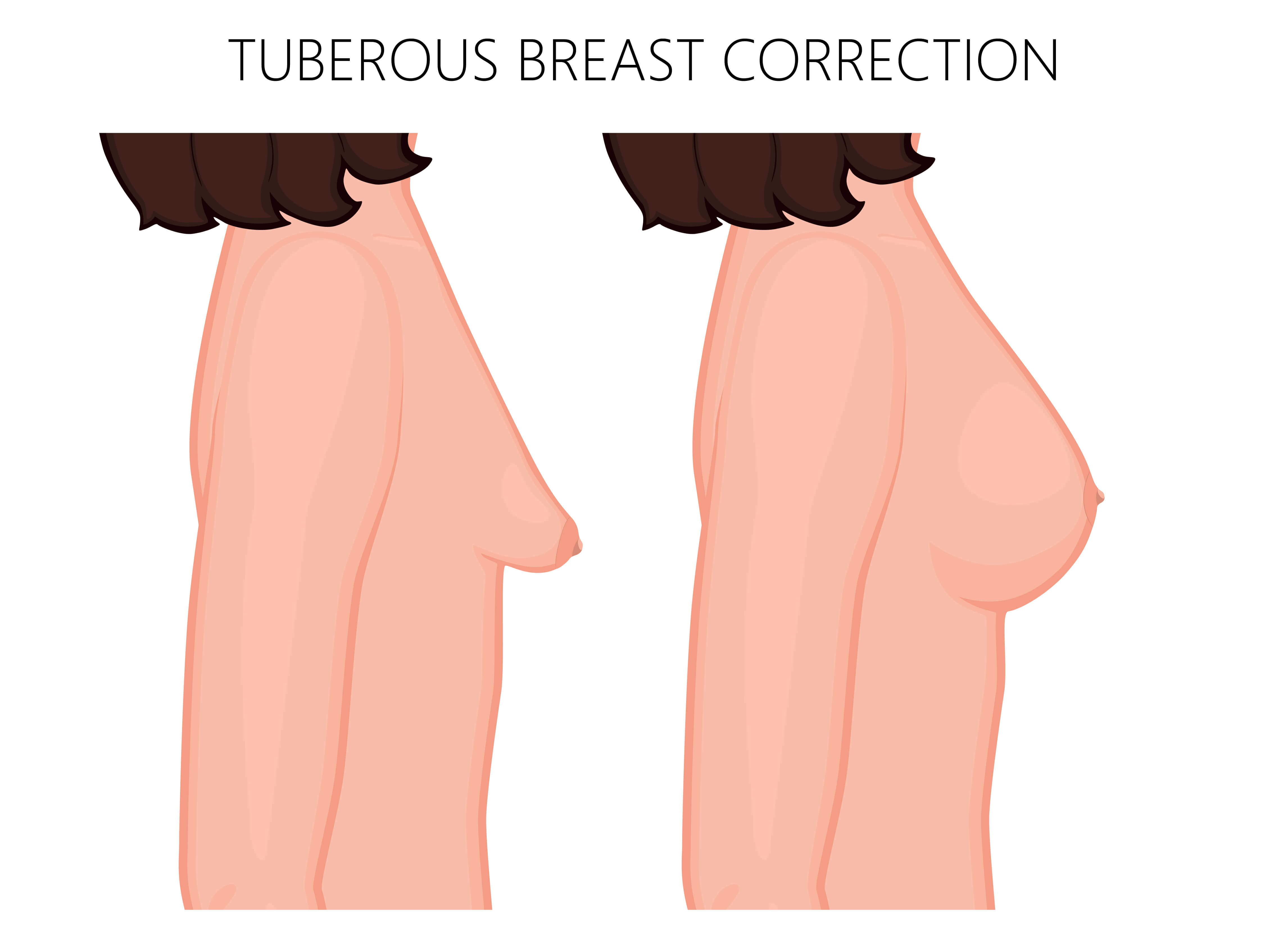 tuberous breasts