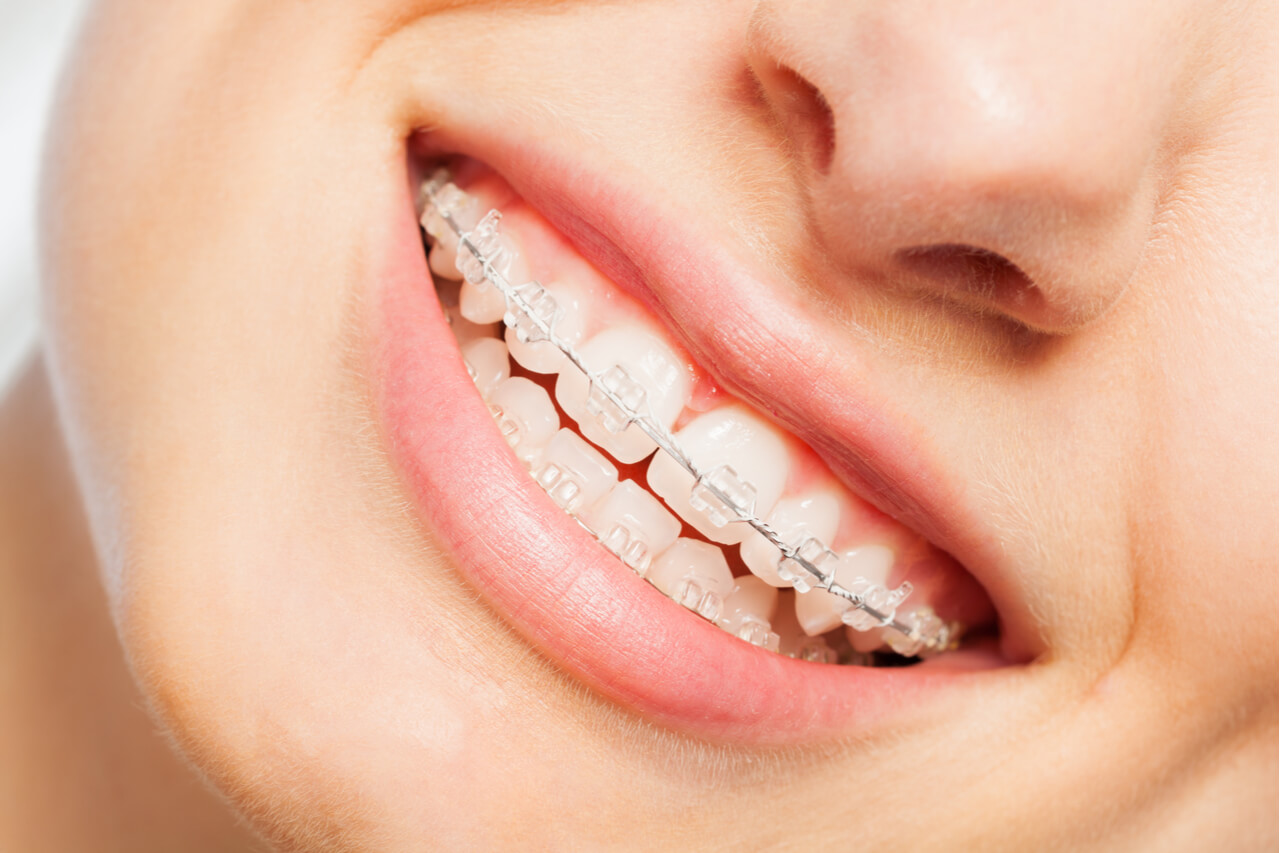 orthodontic braces