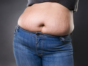 tummy tuck