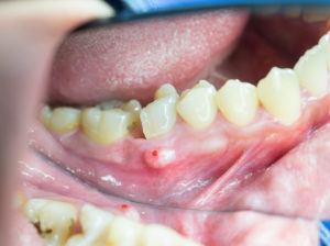 Danger Of Periodontal Disease