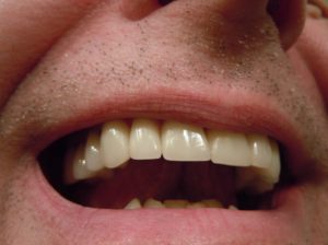 dental crown problem