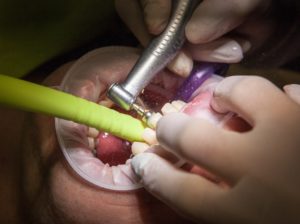 teeth grinding