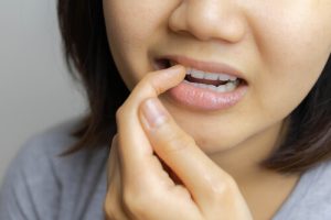 how to treat burned gums from teeth whitening